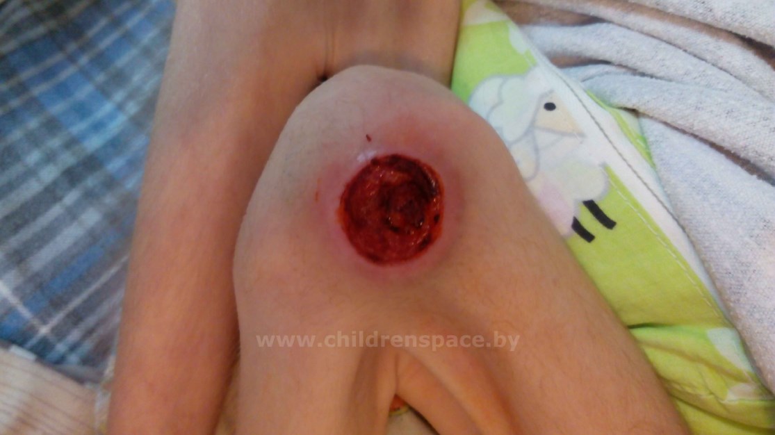 рана  на  колене  до  лечения